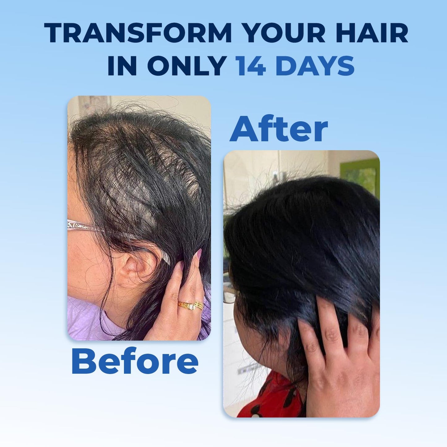 FEGPLUS Minoxidil 5% Rosemary Beard & Hair Growth Serum
