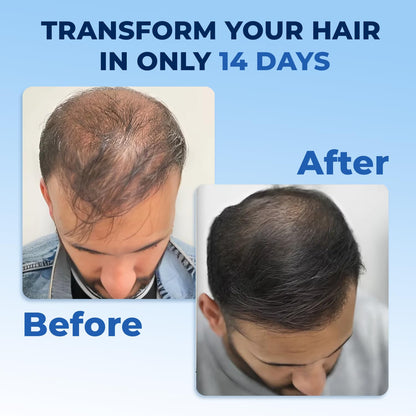 FEGPLUS Minoxidil 5% Rosemary Beard & Hair Growth Serum